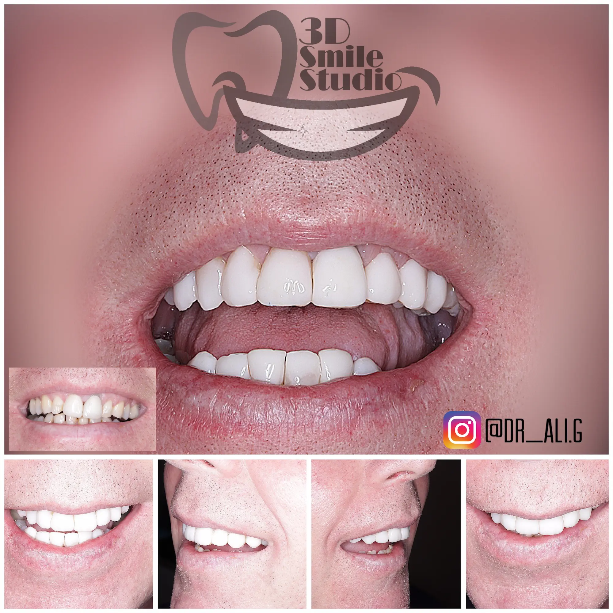 Smile Case 1006a.webp