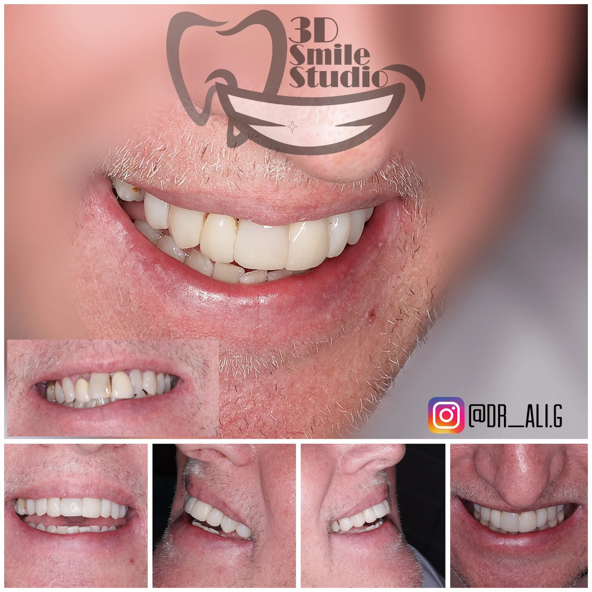 Smile Case 1009a.webp