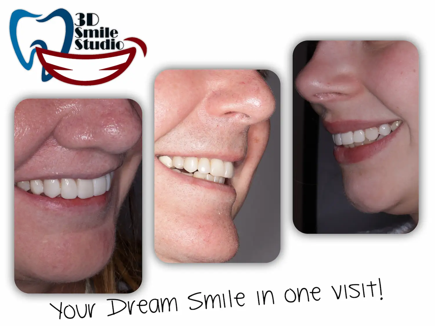 Smile Design & Composite Bonding